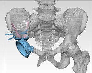 hip arthroplasty system
